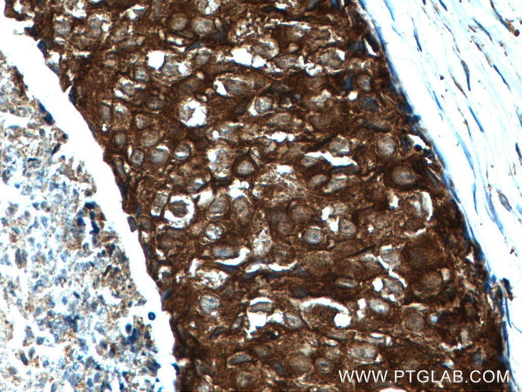 Immunohistochemistry (IHC) staining of human breast cancer tissue using GDI1 Polyclonal antibody (10249-1-AP)