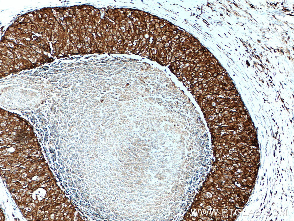 IHC staining of human breast cancer using 10249-1-AP