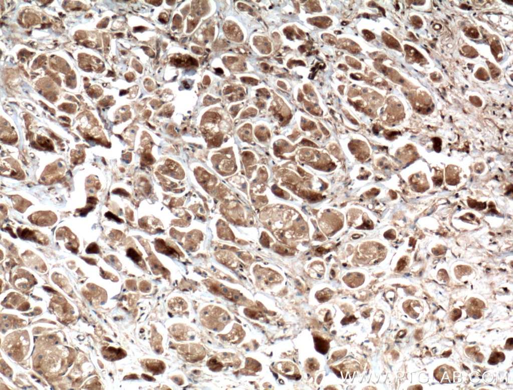 Immunohistochemistry (IHC) staining of human breast cancer tissue using GDI1 Monoclonal antibody (66434-1-Ig)