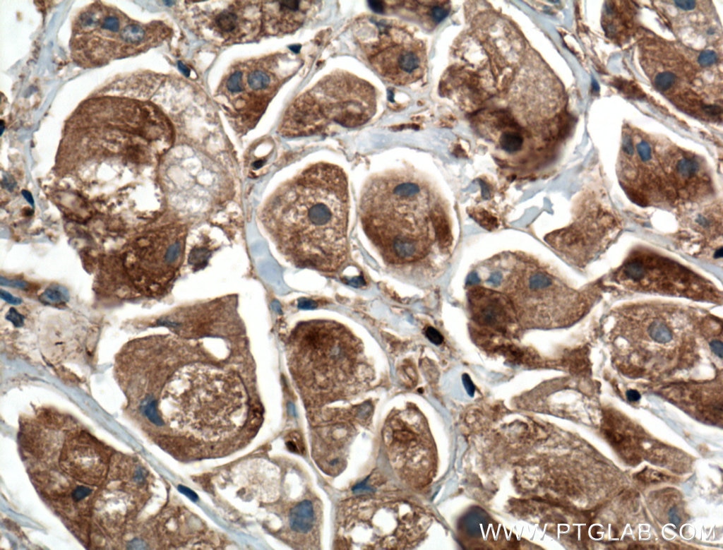 Immunohistochemistry (IHC) staining of human breast cancer tissue using GDI1 Monoclonal antibody (66434-1-Ig)
