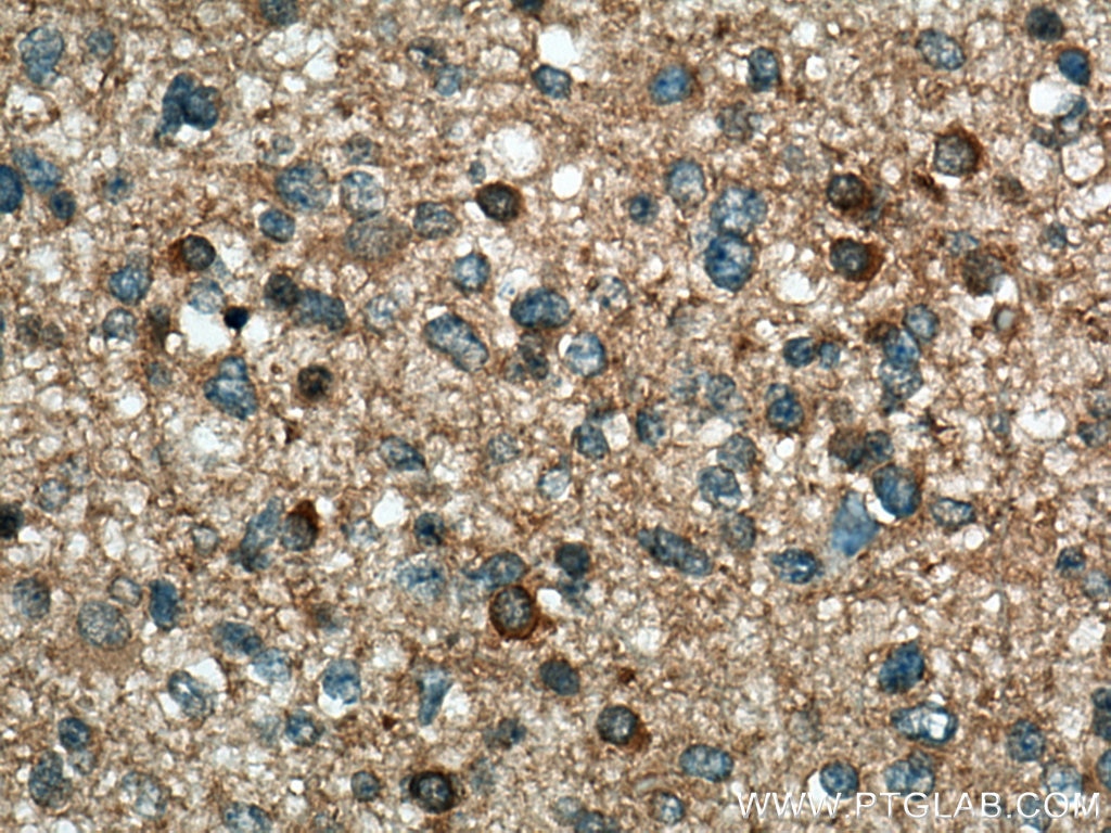 Immunohistochemistry (IHC) staining of human gliomas tissue using GDI2 Polyclonal antibody (10116-1-AP)