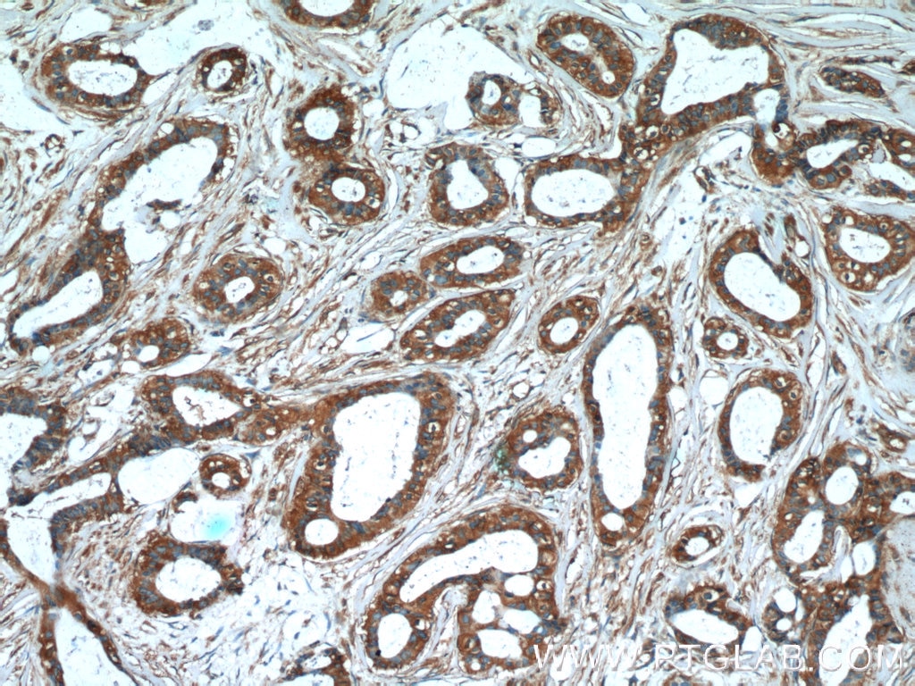 Immunohistochemistry (IHC) staining of human breast cancer tissue using GDI2 Monoclonal antibody (60078-1-Ig)