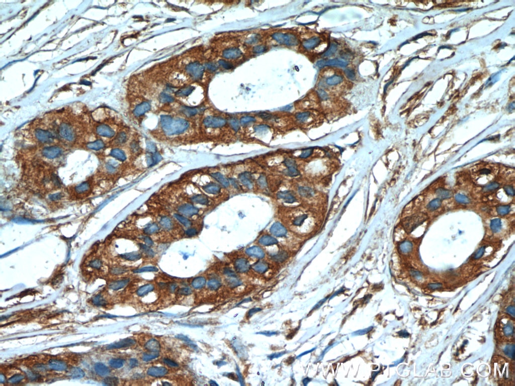 Immunohistochemistry (IHC) staining of human breast cancer tissue using GDI2 Monoclonal antibody (60078-1-Ig)