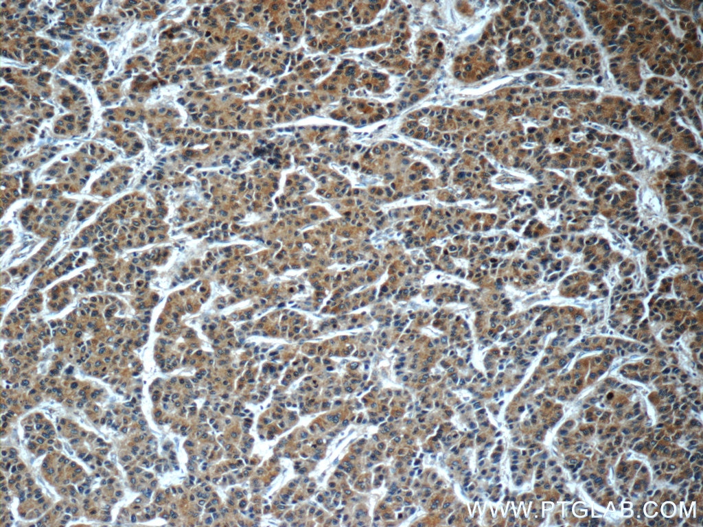 IHC staining of human liver cancer using 60078-1-Ig