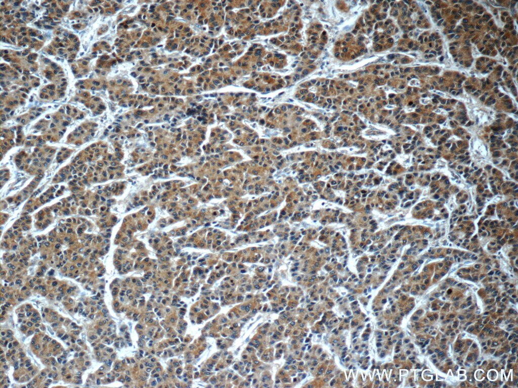 Immunohistochemistry (IHC) staining of human liver cancer tissue using GDI2 Monoclonal antibody (60078-1-Ig)