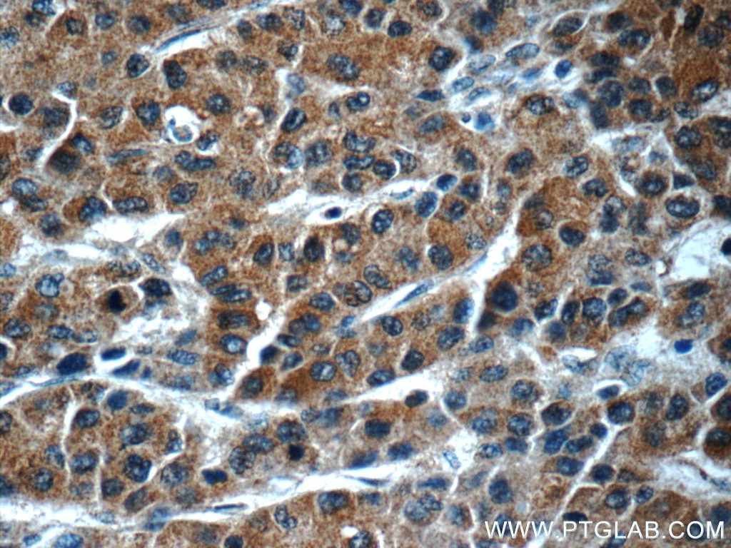 Immunohistochemistry (IHC) staining of human liver cancer tissue using GDI2 Monoclonal antibody (60078-1-Ig)