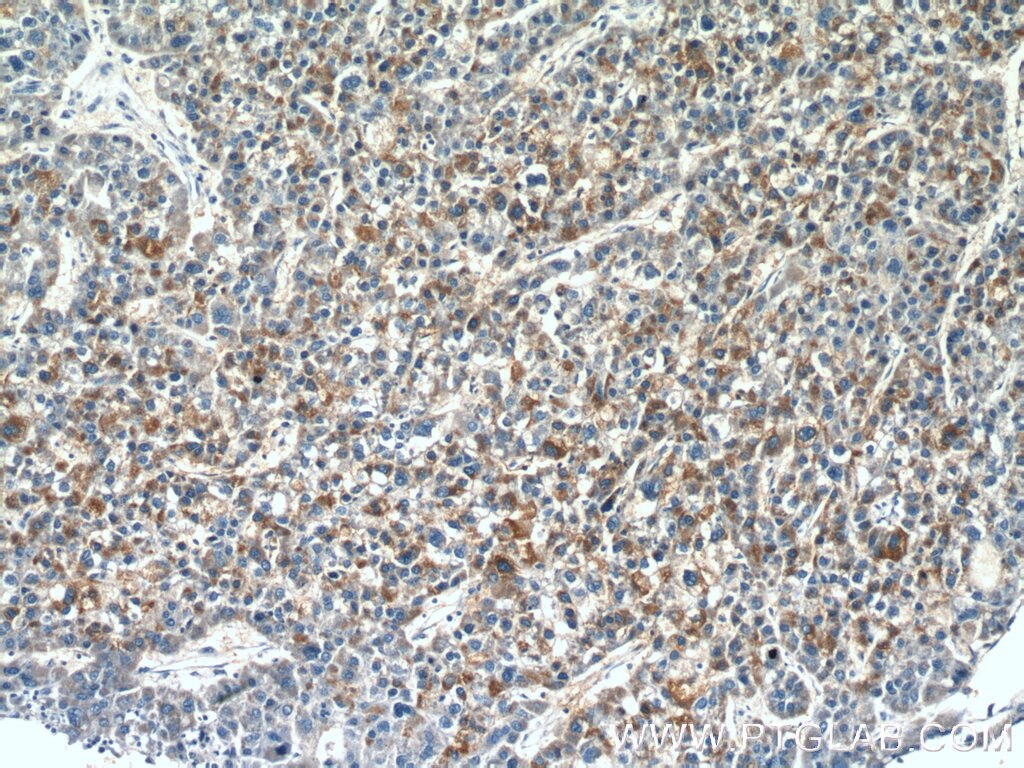Immunohistochemistry (IHC) staining of human liver cancer tissue using GDPD2 Polyclonal antibody (25074-1-AP)