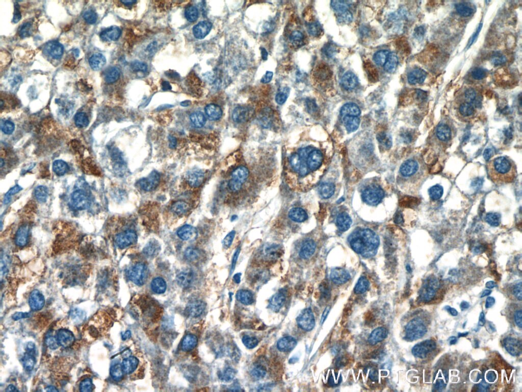 Immunohistochemistry (IHC) staining of human liver cancer tissue using GDPD2 Polyclonal antibody (25074-1-AP)