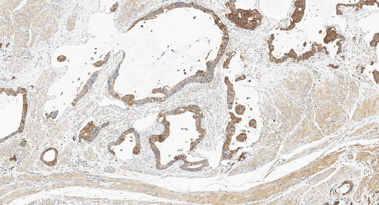 IHC staining of human urothelial carcinoma using 20390-1-AP Immunohistochemistry (IHC) staining of human urothelial carcinoma tissue using GDPD3 Polyclonal antibody (20390-1-AP)