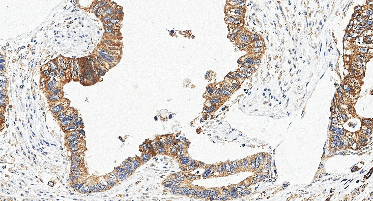 IHC staining of human urothelial carcinoma using 20390-1-AP Immunohistochemistry (IHC) staining of human urothelial carcinoma tissue using GDPD3 Polyclonal antibody (20390-1-AP)
