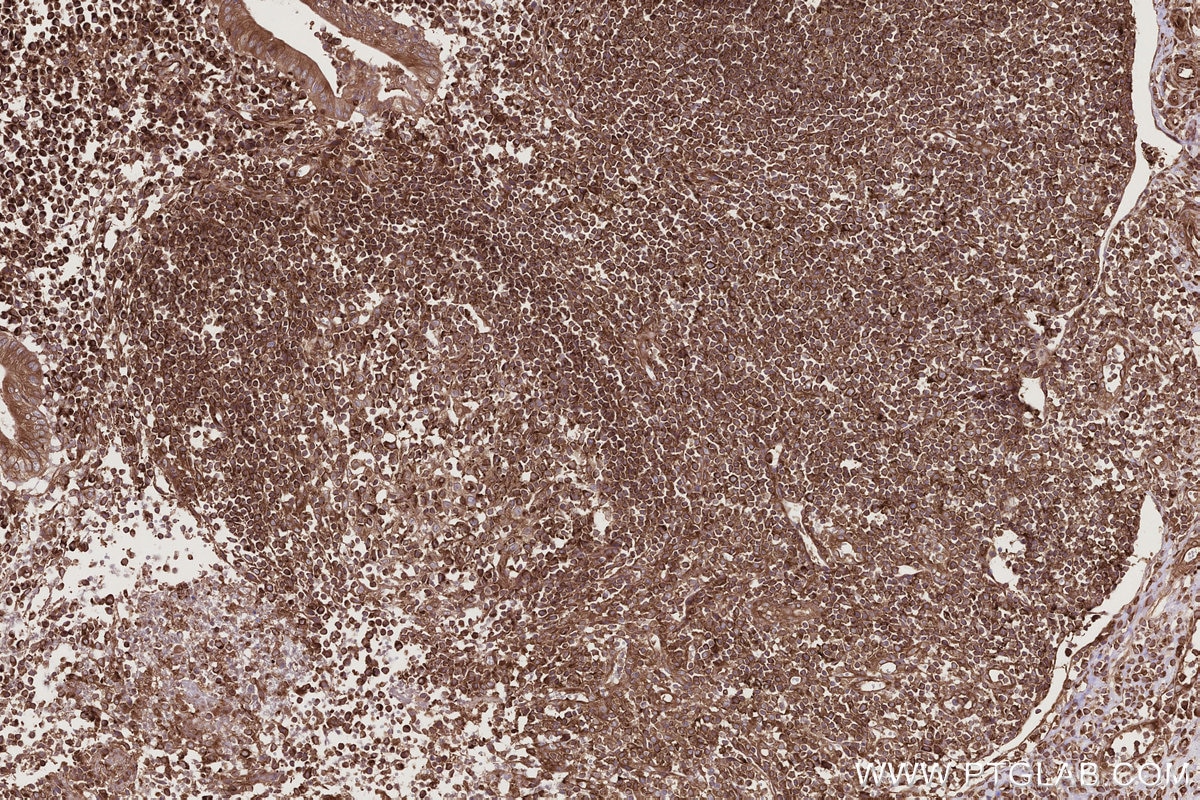 Immunohistochemistry (IHC) staining of human appendicitis tissue using GEF-H1 Polyclonal antibody (24472-1-AP)
