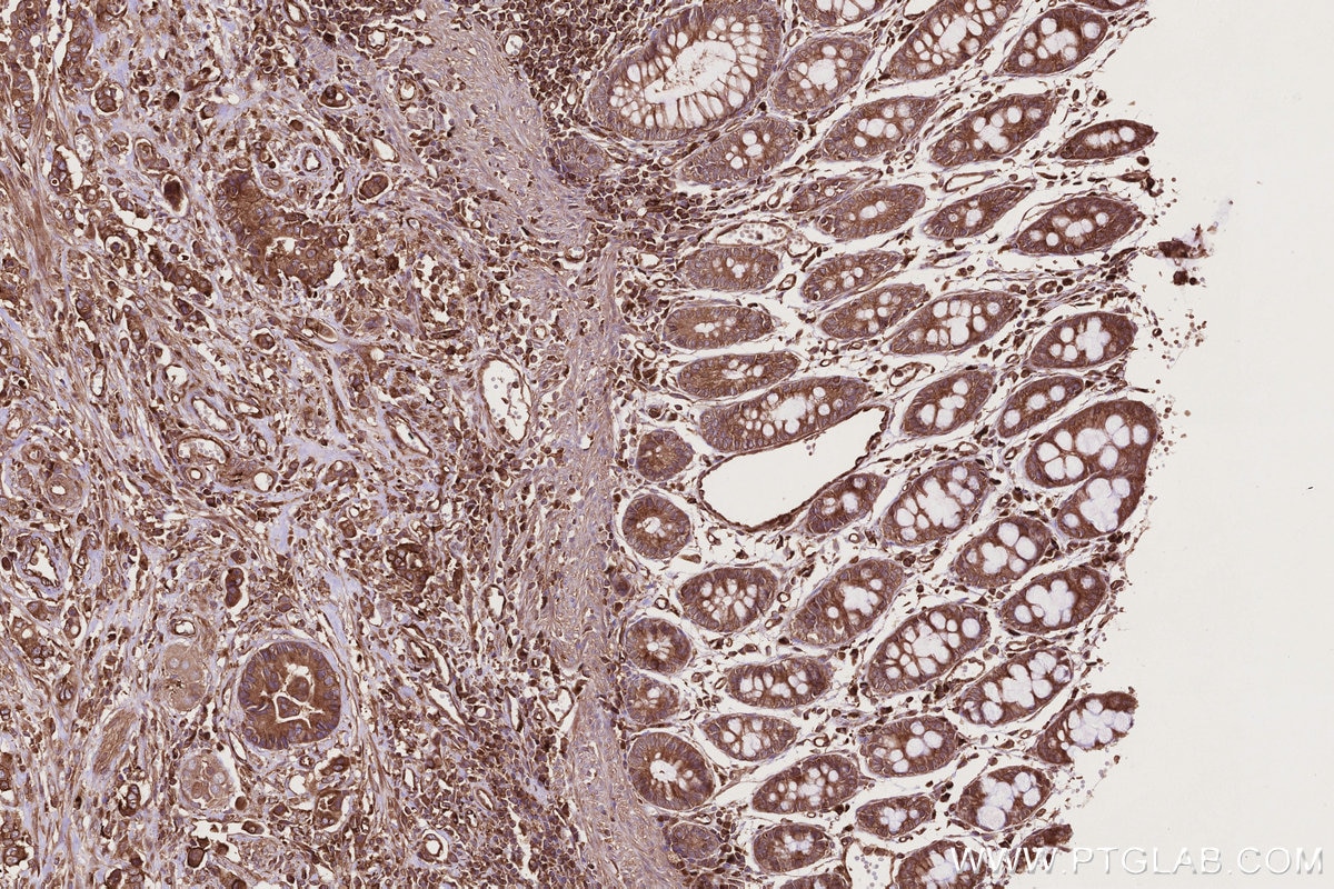 Immunohistochemistry (IHC) staining of human rectal cancer tissue using GEF-H1 Polyclonal antibody (24472-1-AP)