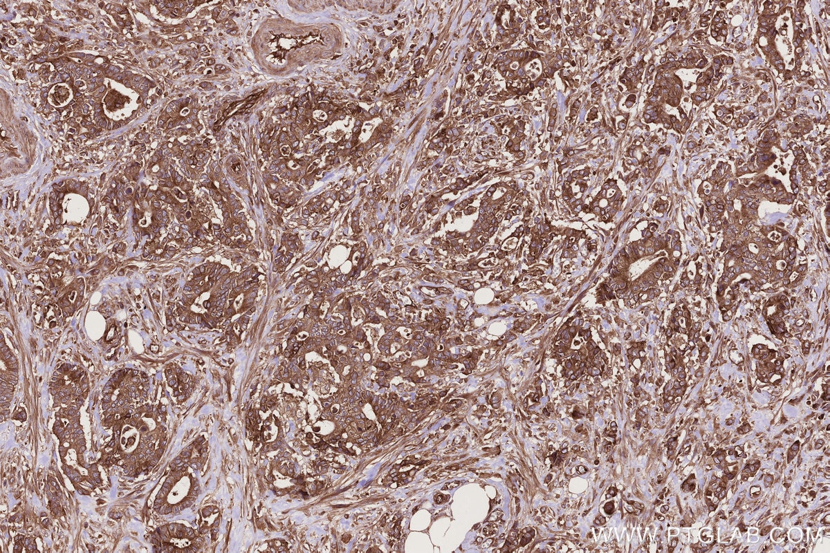 Immunohistochemistry (IHC) staining of human rectal cancer tissue using GEF-H1 Polyclonal antibody (24472-1-AP)