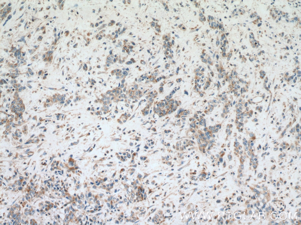 Immunohistochemistry (IHC) staining of human stomach cancer tissue using GEF-H1 Polyclonal antibody (24472-1-AP)