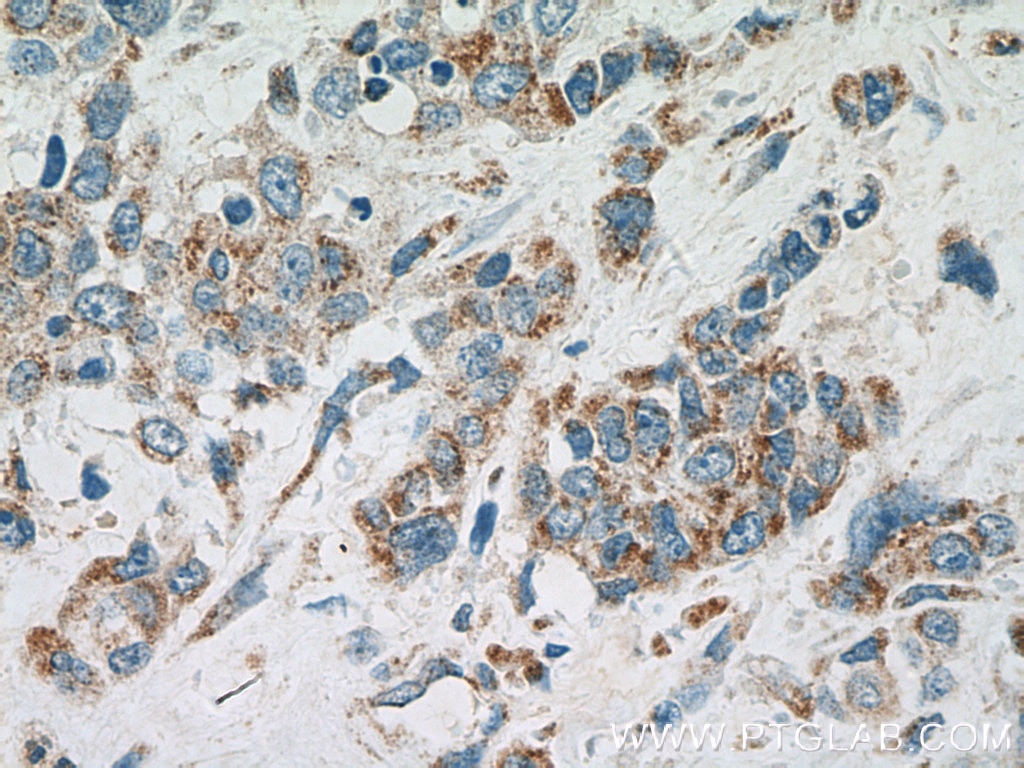 IHC staining of human stomach cancer using 24472-1-AP