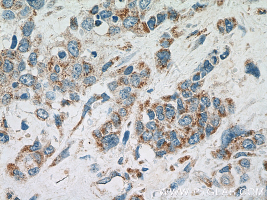 Immunohistochemistry (IHC) staining of human stomach cancer tissue using GEF-H1 Polyclonal antibody (24472-1-AP)