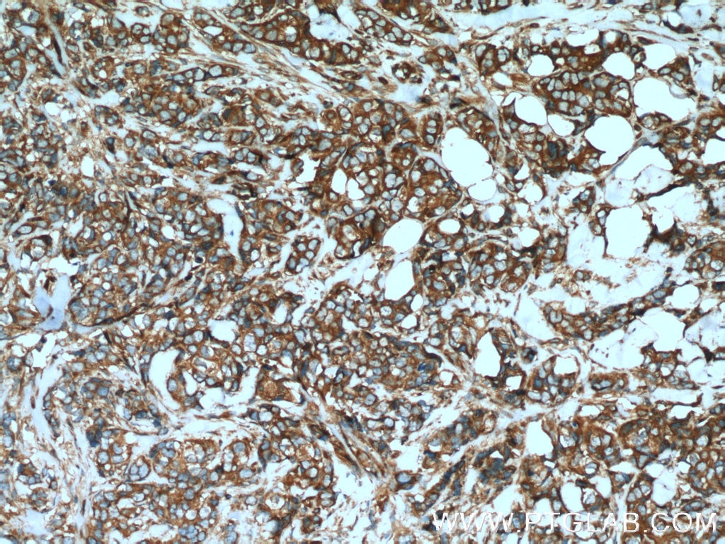 Immunohistochemistry (IHC) staining of human breast cancer tissue using GEF-H1 Polyclonal antibody (24472-1-AP)