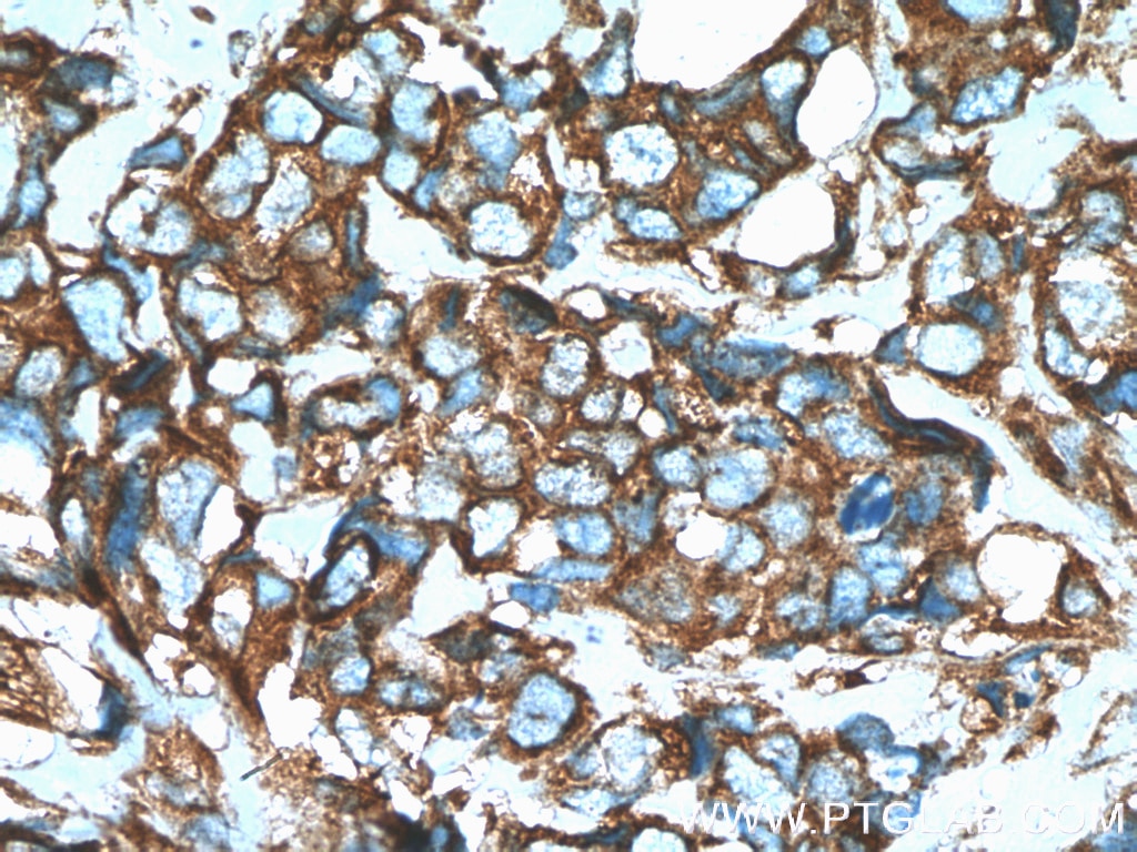 Immunohistochemistry (IHC) staining of human breast cancer tissue using GEF-H1 Polyclonal antibody (24472-1-AP)