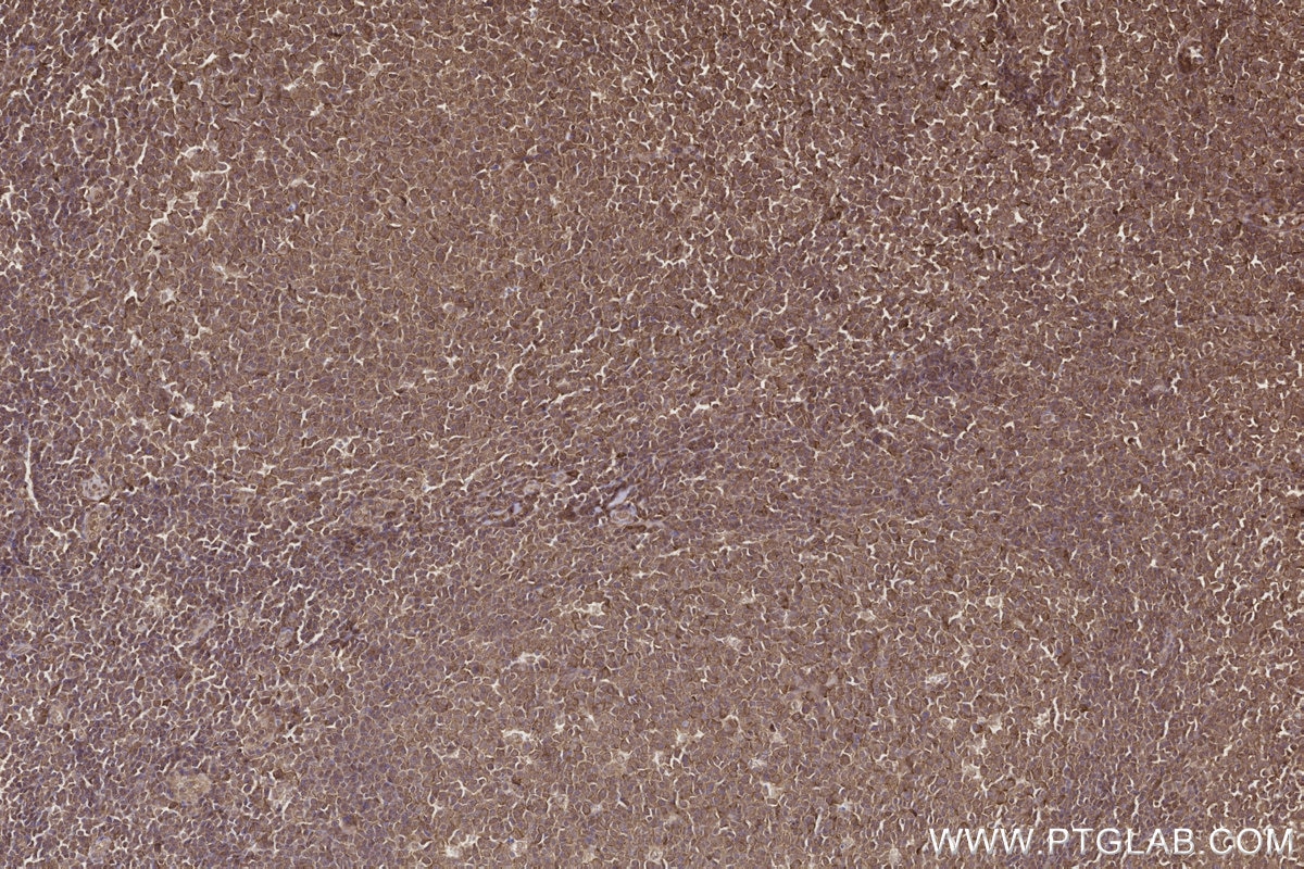 IHC staining of human tonsillitis using 84171-5-RR Immunohistochemistry (IHC) staining of human tonsillitis tissue using GEMIN5 Recombinant monoclonal antibody (84171-5-RR)