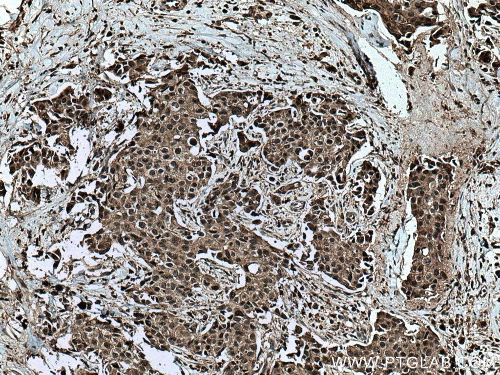 Immunohistochemistry (IHC) staining of human breast cancer tissue using GEMIN6 Polyclonal antibody (12307-2-AP)