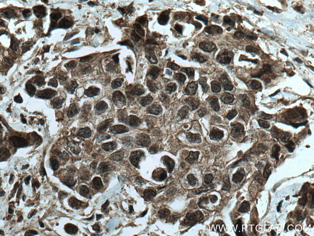 Immunohistochemistry (IHC) staining of human breast cancer tissue using GEMIN6 Polyclonal antibody (12307-2-AP)