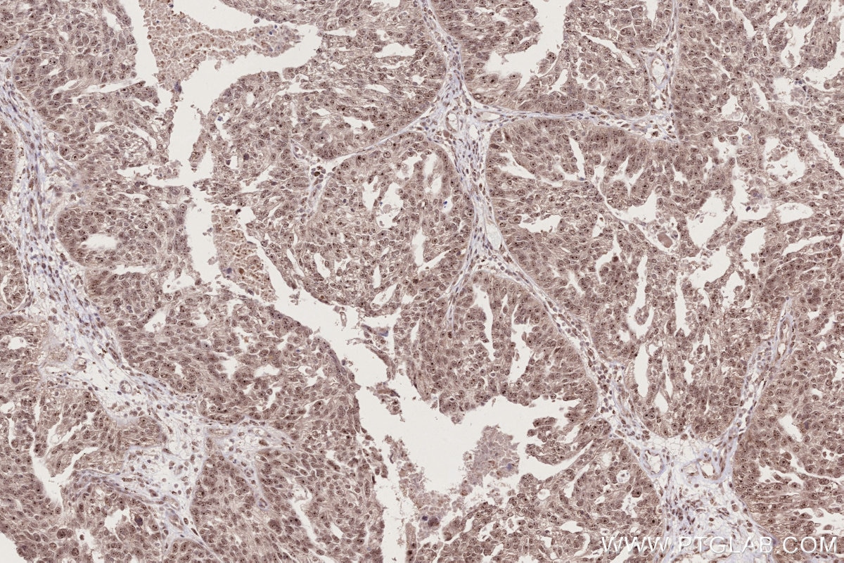 Immunohistochemistry (IHC) staining of human ovary cancer tissue using GEMIN6 Polyclonal antibody (12307-2-AP)
