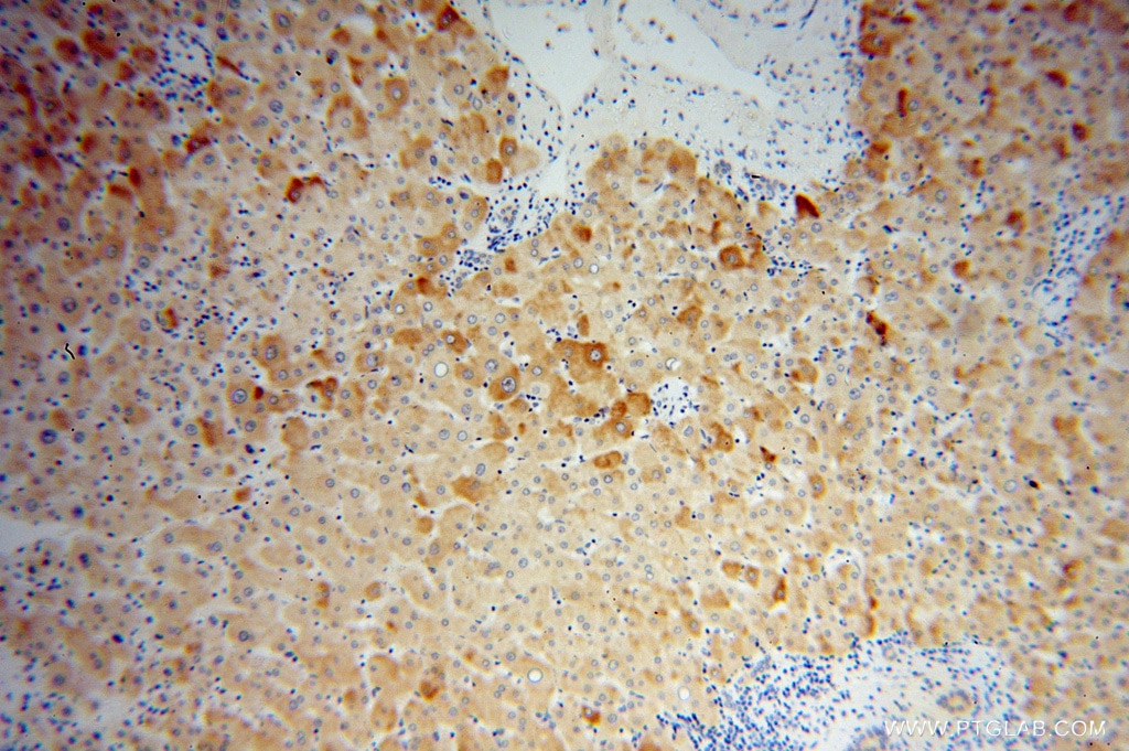 Immunohistochemistry (IHC) staining of human liver cancer tissue using GEMIN8 Polyclonal antibody (15251-1-AP)