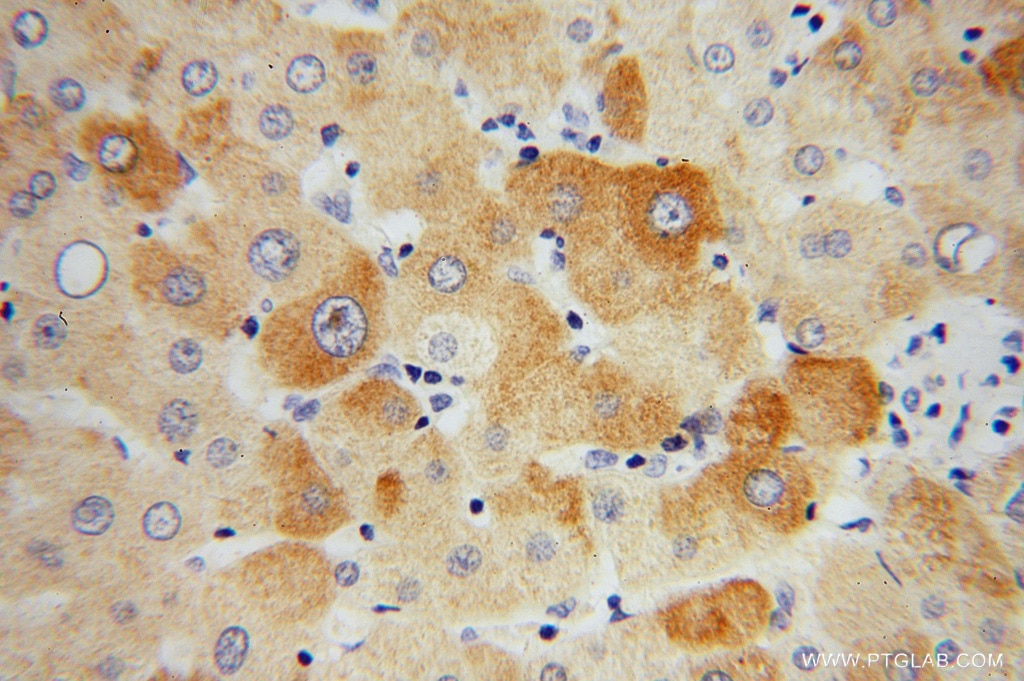 Immunohistochemistry (IHC) staining of human liver cancer tissue using GEMIN8 Polyclonal antibody (15251-1-AP)