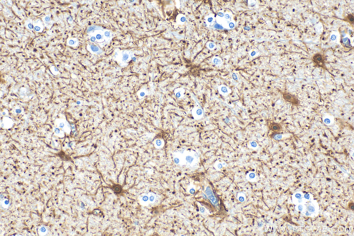 Immunohistochemistry (IHC) staining of human brain tissue using GFAP Polyclonal antibody (16825-1-AP)