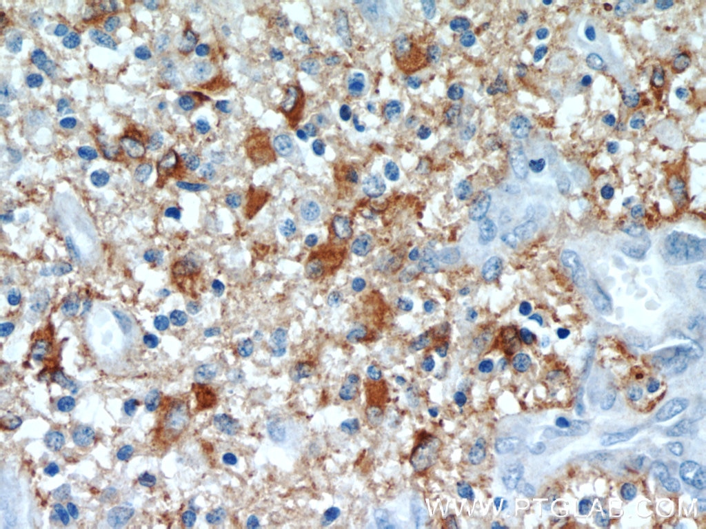 Immunohistochemistry (IHC) staining of human gliomas tissue using GFAP Polyclonal antibody (23935-1-AP)