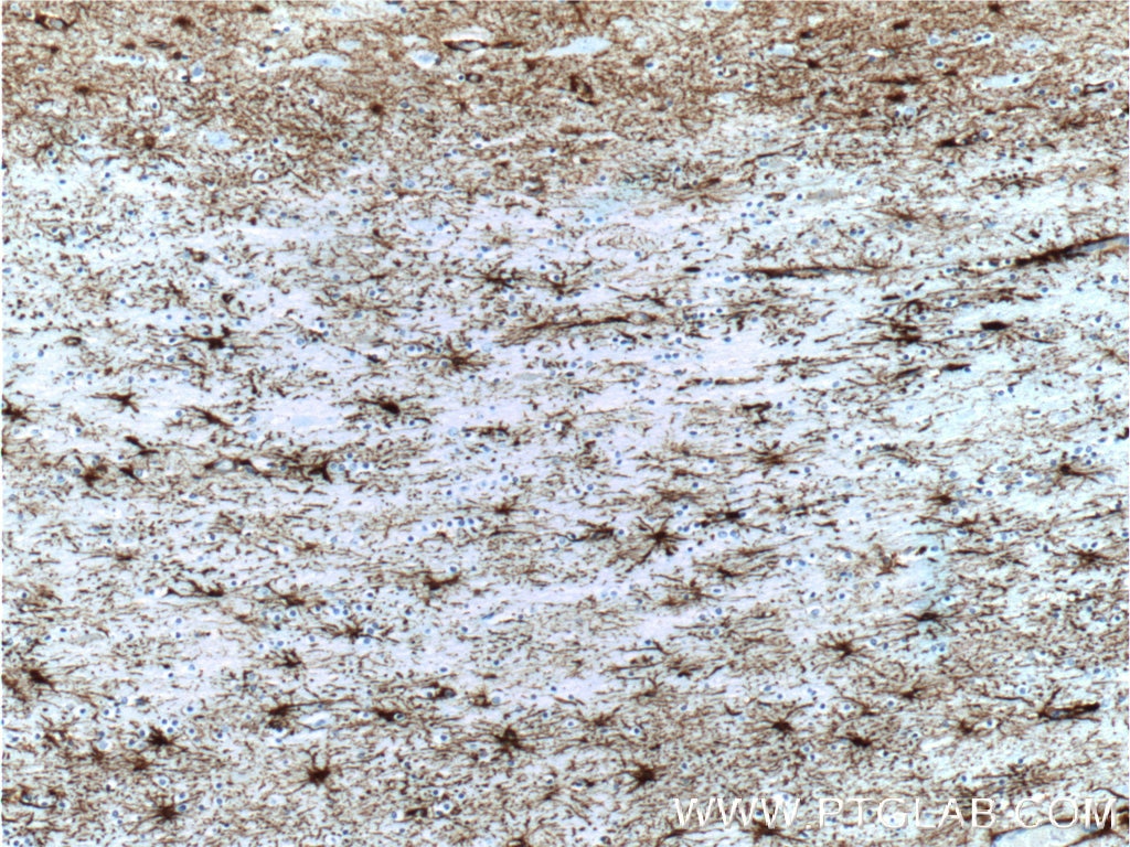 Immunohistochemistry (IHC) staining of human brain tissue using GFAP Monoclonal antibody (60190-1-Ig)