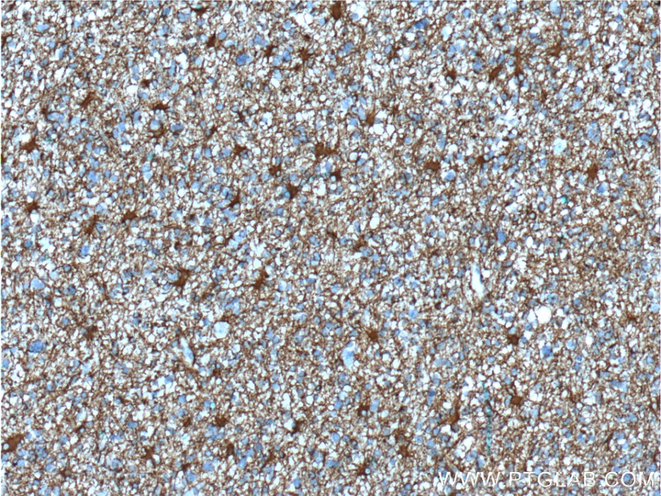 IHC staining of human gliomas using 60190-1-Ig