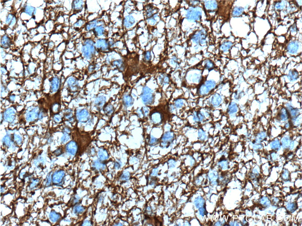 Immunohistochemistry (IHC) staining of human gliomas tissue using GFAP Monoclonal antibody (60190-1-Ig)