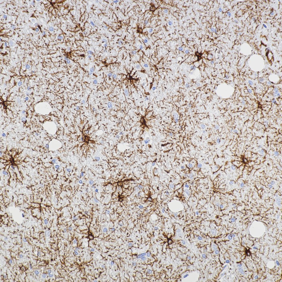 Immunohistochemistry (IHC) staining of human brain tissue using GFAP Recombinant monoclonal antibody (81063-1-RR)