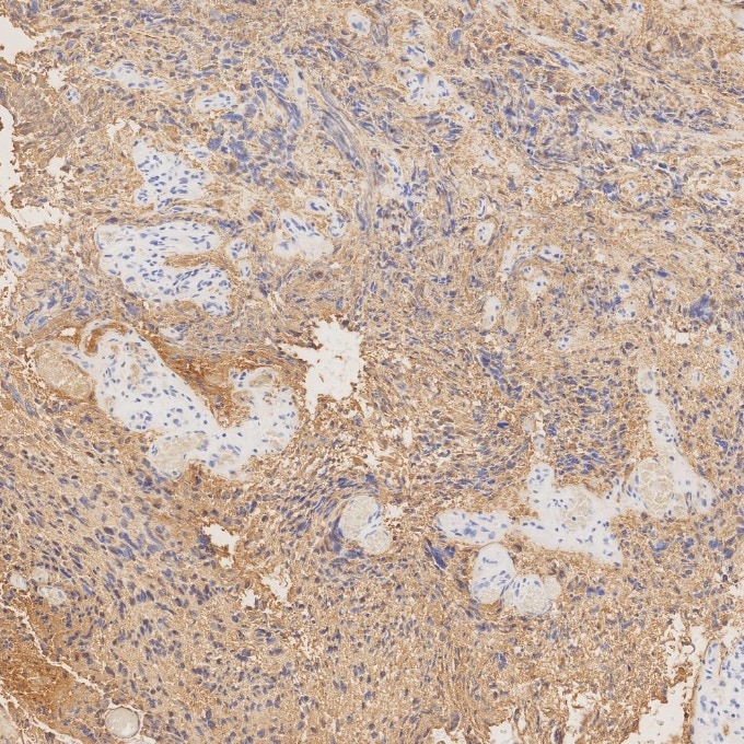 Immunohistochemistry (IHC) staining of human gliomas tissue using GFAP Recombinant monoclonal antibody (81063-1-RR)