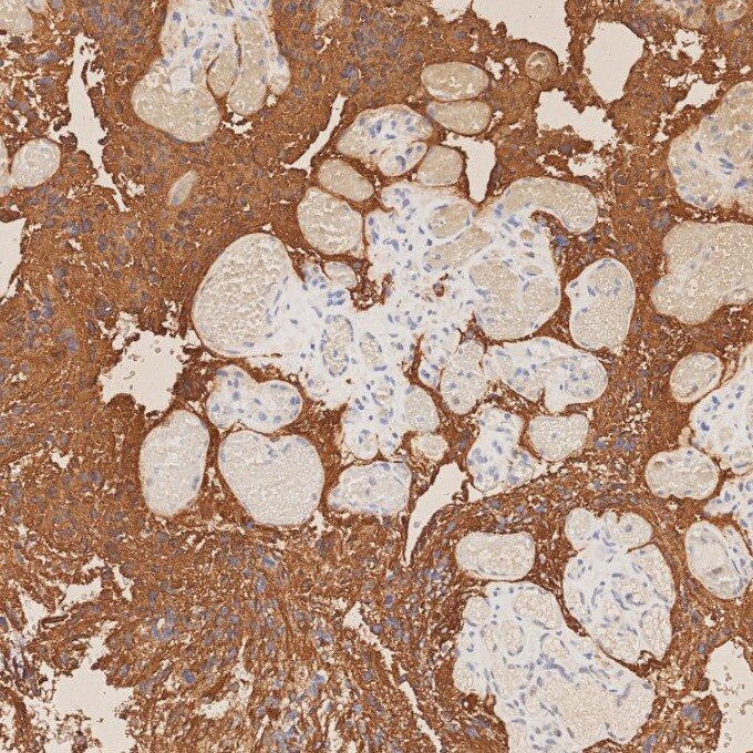 Immunohistochemistry (IHC) staining of human gliomas tissue using GFAP Recombinant monoclonal antibody (81063-1-RR)