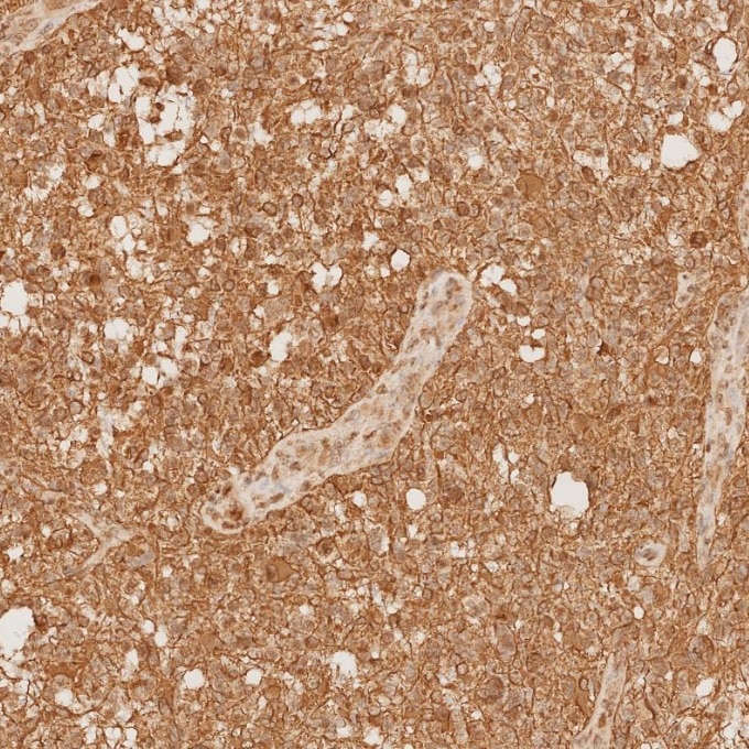 Immunohistochemistry (IHC) staining of human gliomas tissue using GFAP Recombinant monoclonal antibody (81063-1-RR)