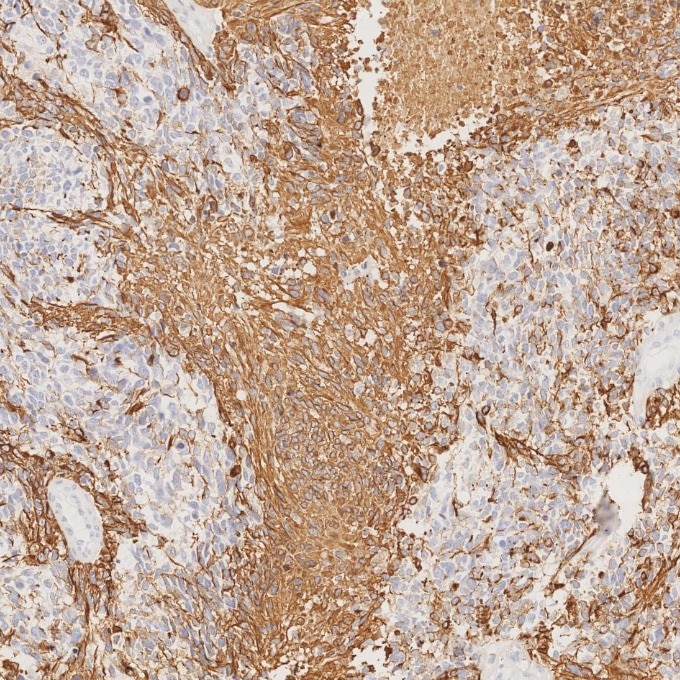 Immunohistochemistry (IHC) staining of human gliomas tissue using GFAP Recombinant monoclonal antibody (81063-1-RR)