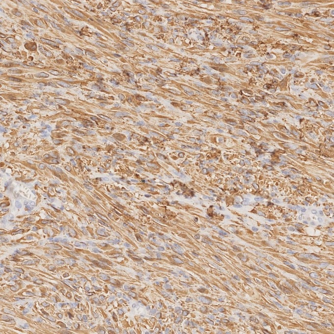 Immunohistochemistry (IHC) staining of human gliomas tissue using GFAP Recombinant monoclonal antibody (81063-1-RR)