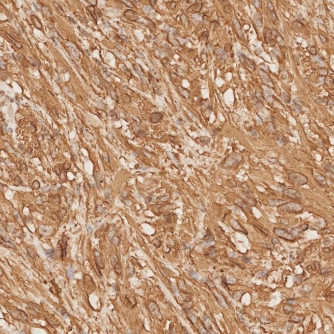 Immunohistochemistry (IHC) staining of human gliomas tissue using GFAP Recombinant monoclonal antibody (81063-1-RR)
