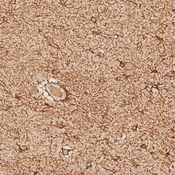 Immunohistochemistry (IHC) staining of human brain tissue using GFAP Recombinant monoclonal antibody (81063-1-RR)