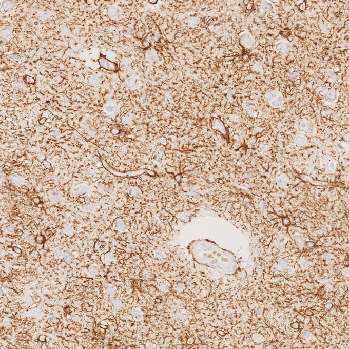 Immunohistochemistry (IHC) staining of human brain tissue using GFAP Recombinant monoclonal antibody (81063-1-RR)