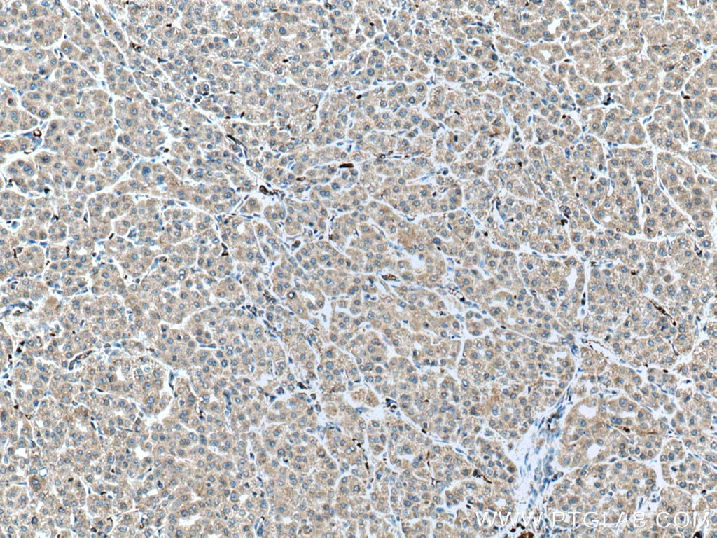 Immunohistochemistry (IHC) staining of human liver cancer tissue using ALR Polyclonal antibody (11293-1-AP)