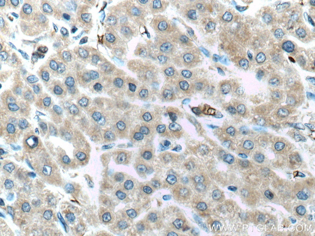 Immunohistochemistry (IHC) staining of human liver cancer tissue using ALR Polyclonal antibody (11293-1-AP)