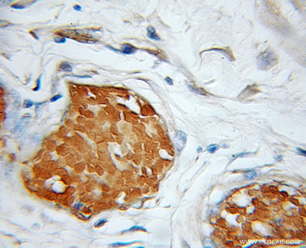 Immunohistochemistry (IHC) staining of human colon cancer tissue using ALR Polyclonal antibody (11293-1-AP)