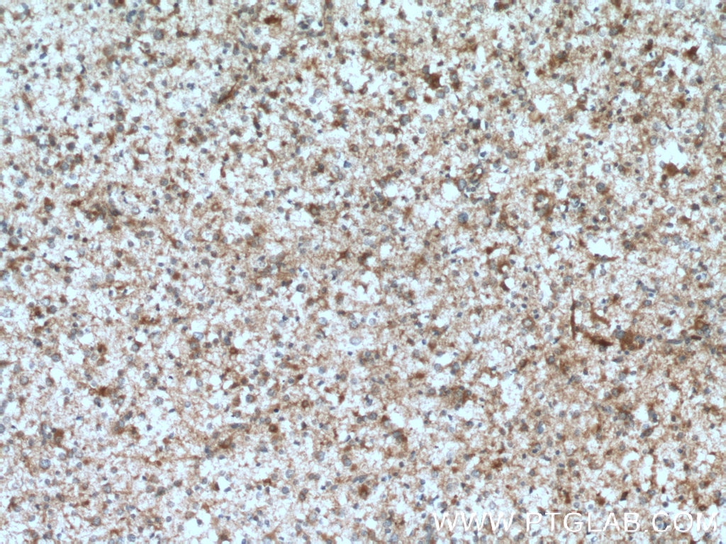 Immunohistochemistry (IHC) staining of human gliomas tissue using GFPT1 Polyclonal antibody (14132-1-AP)