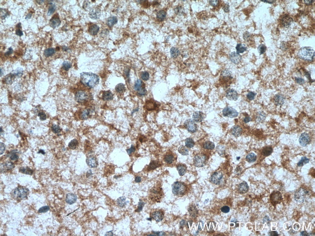 Immunohistochemistry (IHC) staining of human gliomas tissue using GFPT1 Polyclonal antibody (14132-1-AP)