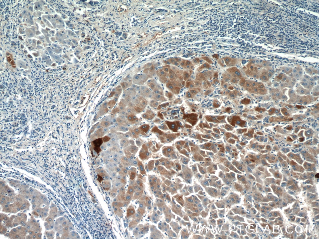 Immunohistochemistry (IHC) staining of human hepatocirrhosis tissue using GFPT1 Polyclonal antibody (14132-1-AP)