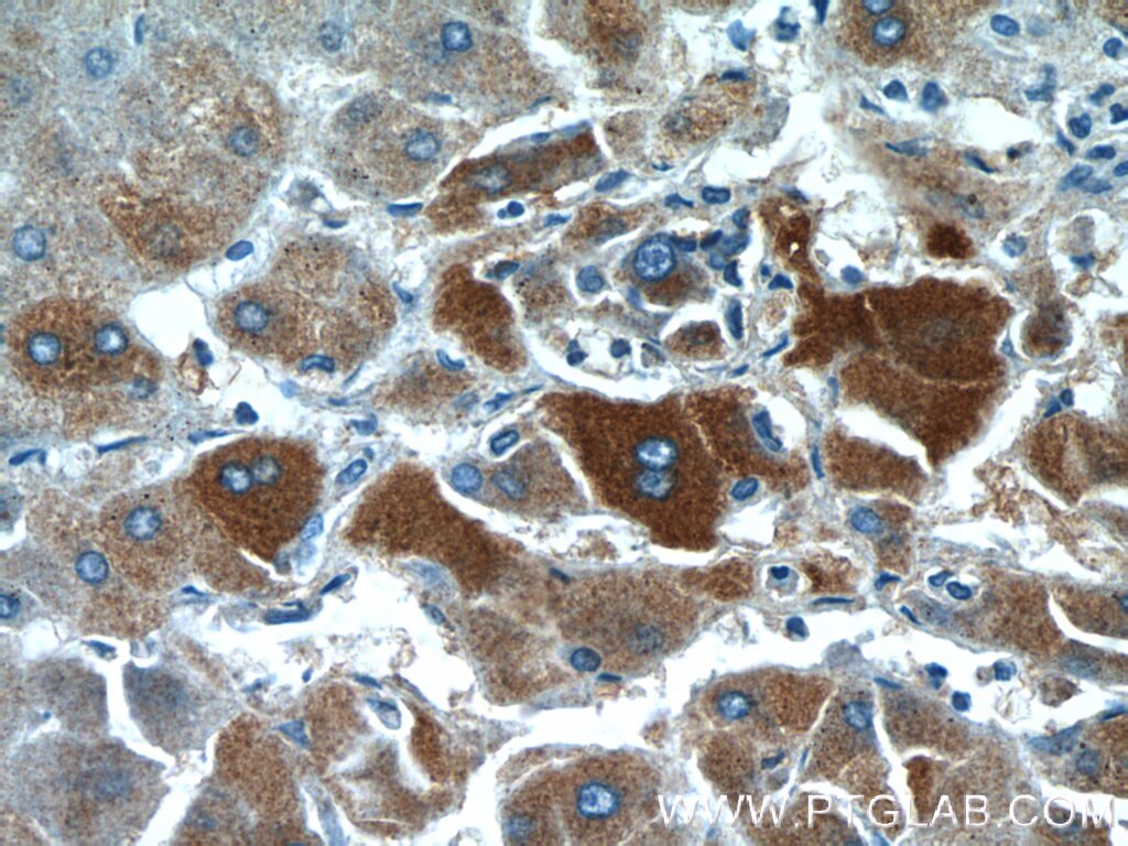 Immunohistochemistry (IHC) staining of human hepatocirrhosis tissue using GFPT1 Polyclonal antibody (14132-1-AP)