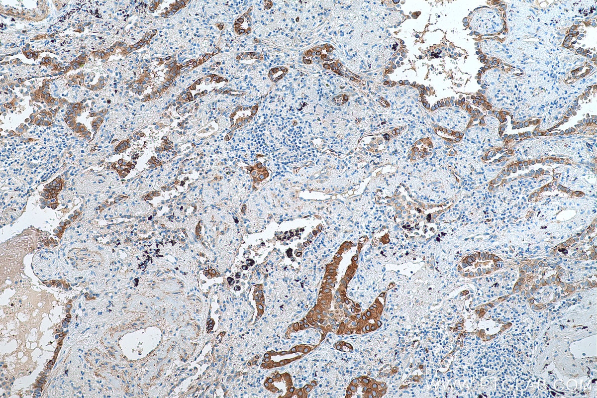 Immunohistochemistry (IHC) staining of human lung cancer tissue using GFRA2 Polyclonal antibody (55038-1-AP)